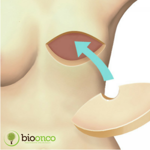 Reconstruções mamárias