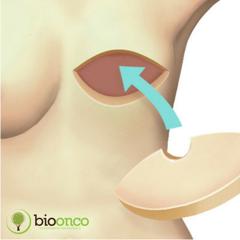 Reconstruções mamárias