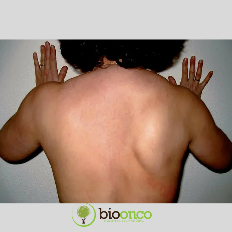 Complicação pós mastectomia