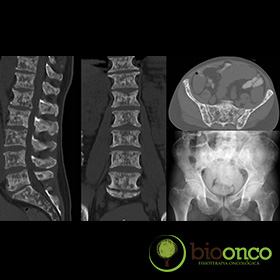 Fisioterapia oncológica