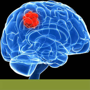 Tumores cerebrais