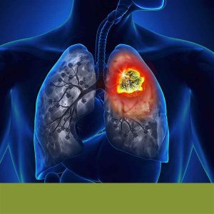 Cancer Pulmao