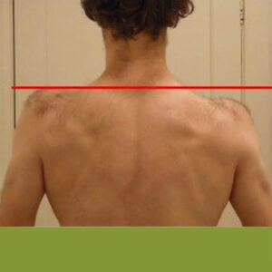 Síndrome do Ombro Caído