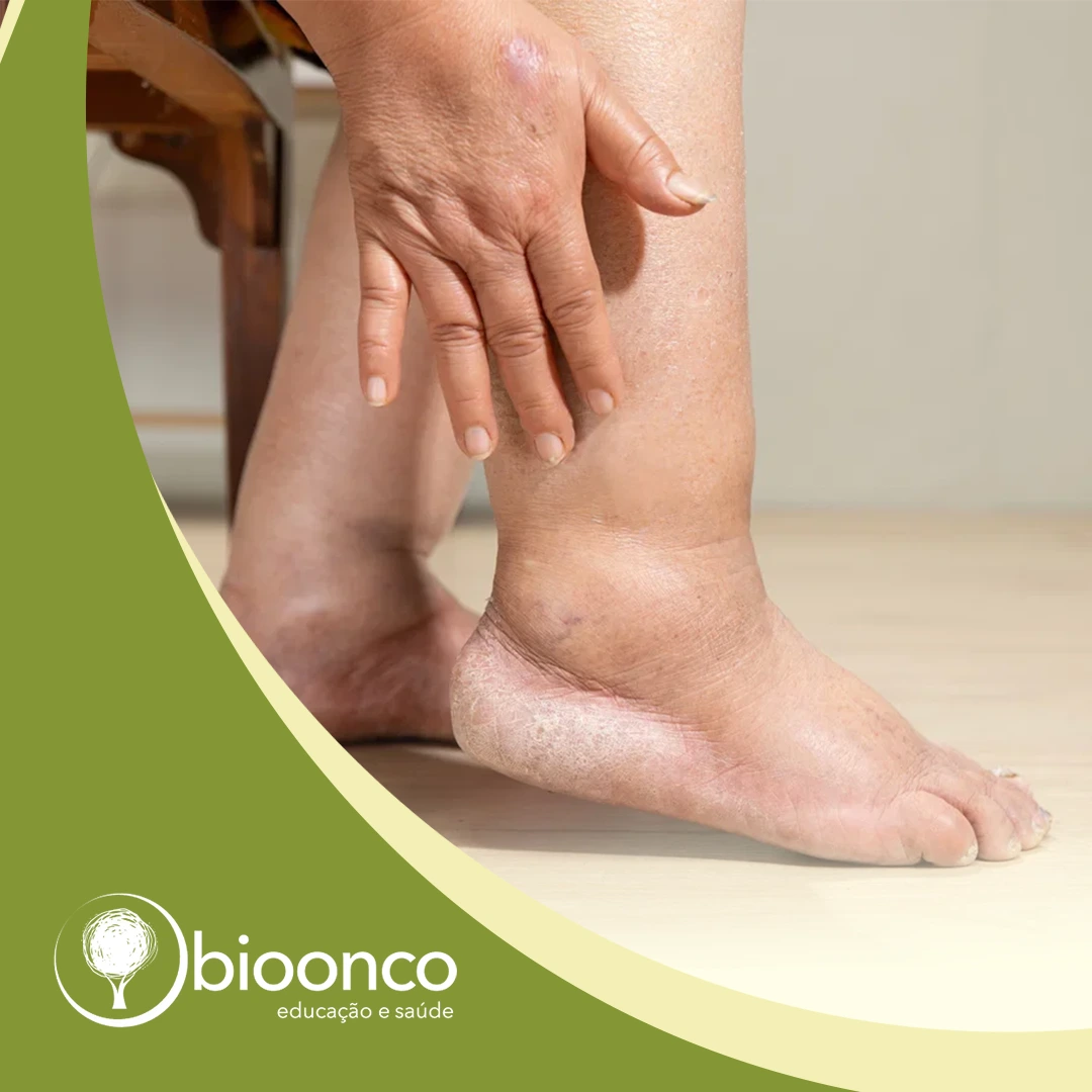 Fisioterapia en Cáncer y Linfedema